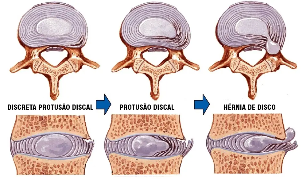 Qual a diferença entre Protrusão e Hérnia Discal